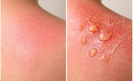 Érythème solaire : différence avec un coup de soleil