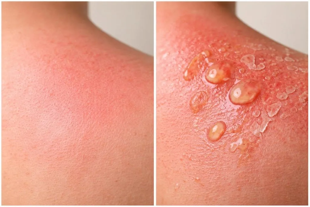 découvrez les différences entre l'érythème solaire et le coup de soleil, leurs causes, symptômes et conseils pour protéger votre peau efficacement.