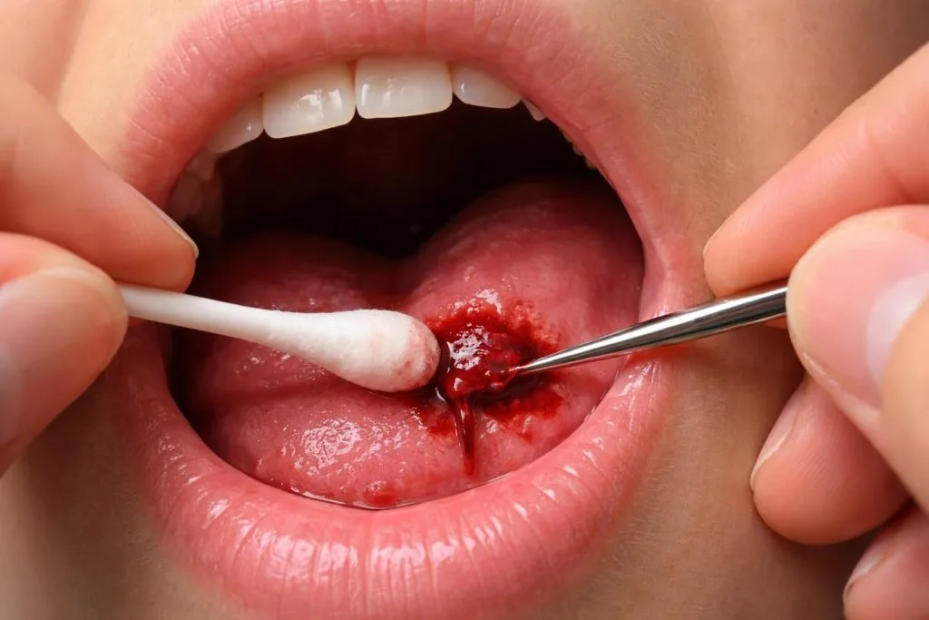 découvrez les erreurs courantes à éviter pour enlever une boule de sang dans la bouche en toute sécurité et efficacement. guide pratique et conseils santé indispensables.